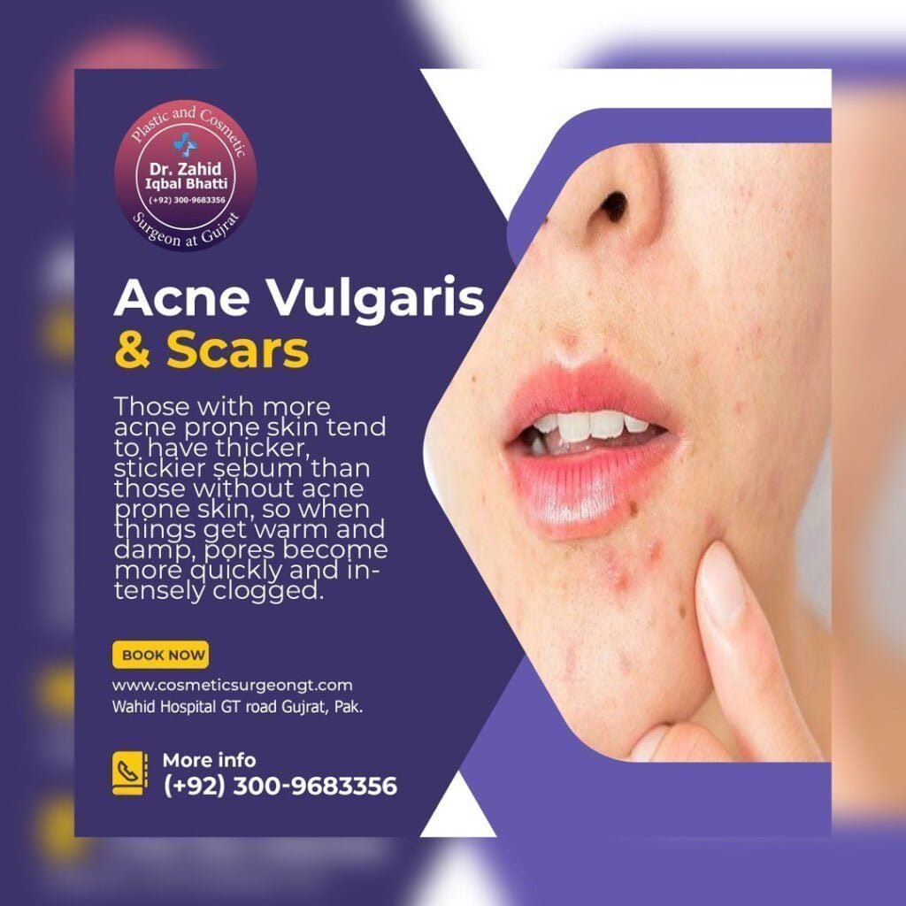 Acne Vulgaris Social Media Banner