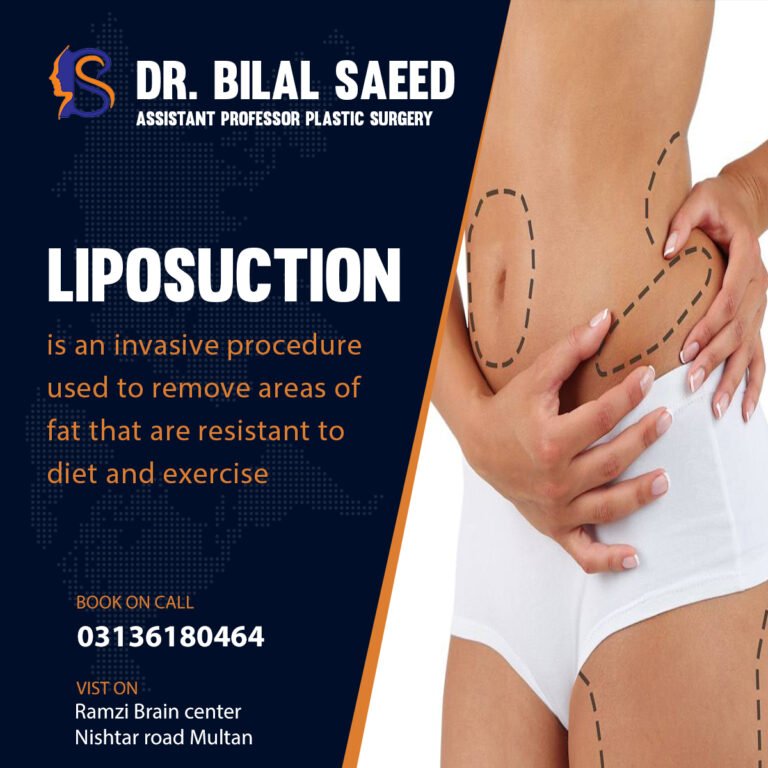 Liposuction