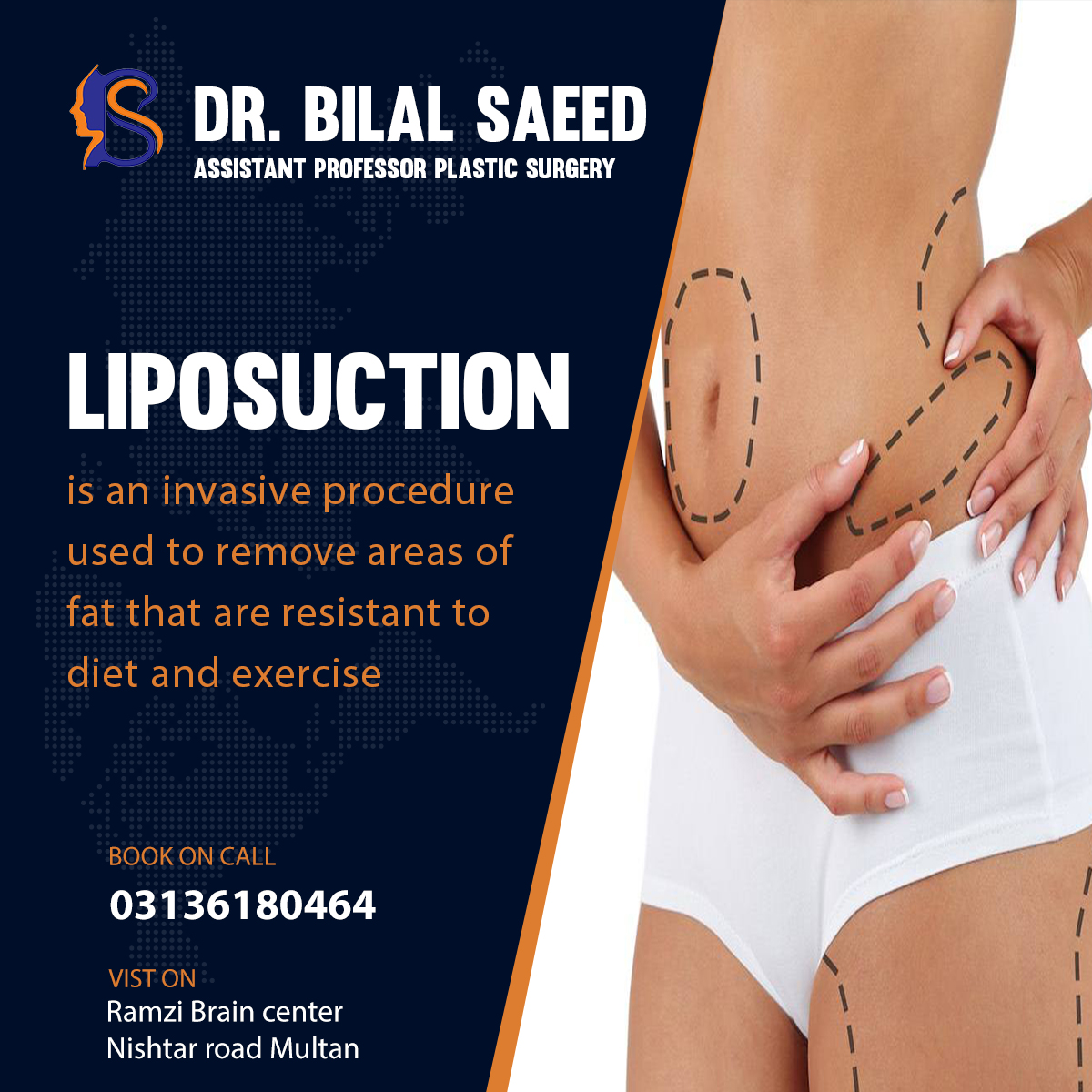 liposuction