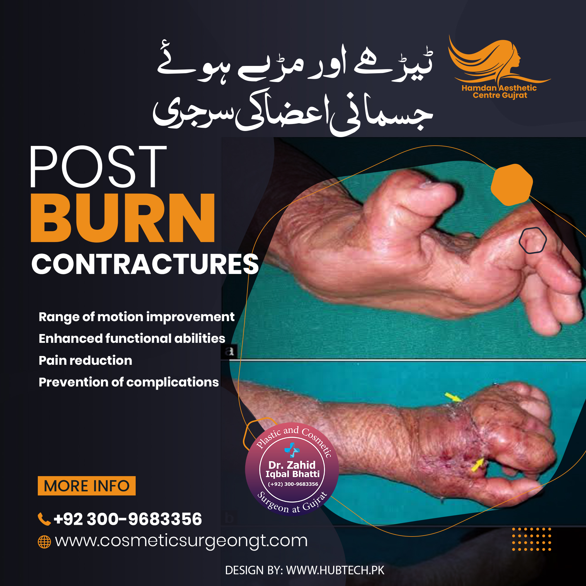 Post burn contracture